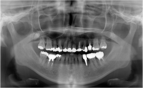河合１　初診時